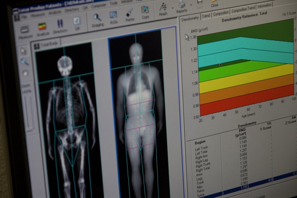 Bone density scan results on a computer screen.